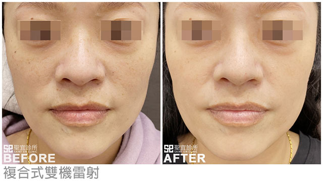 複合式雙機雷射．dr龍勤莉