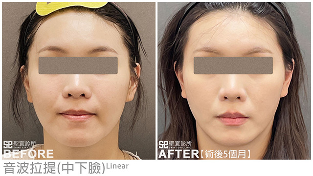 音波拉提(中下臉+雙下巴)．dr林庭伊