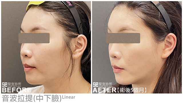 音波拉提(中下臉+雙下巴)．dr林庭伊