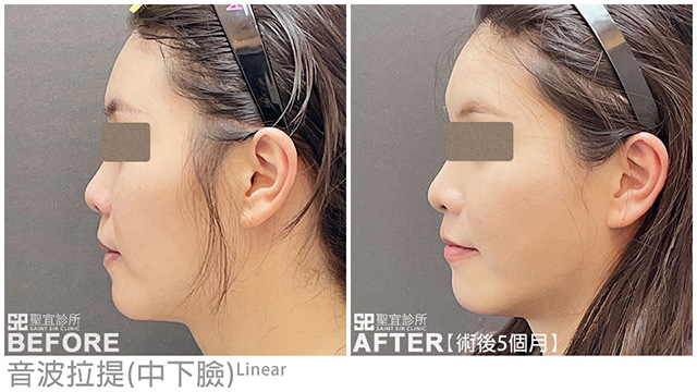 音波拉提(中下臉+雙下巴)．dr林庭伊