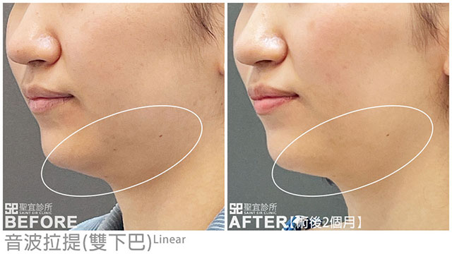 音波拉提案例見證(雙下巴)