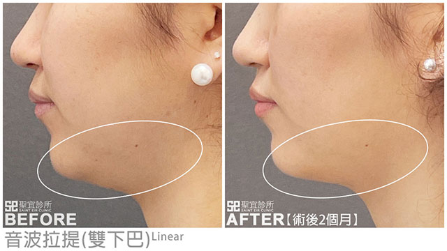 音波拉提案例見證(雙下巴)