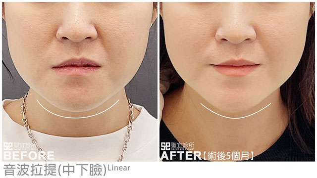 音波拉提案例見證(中下臉)
