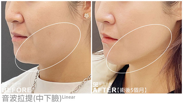 音波拉提案例見證(中下臉)