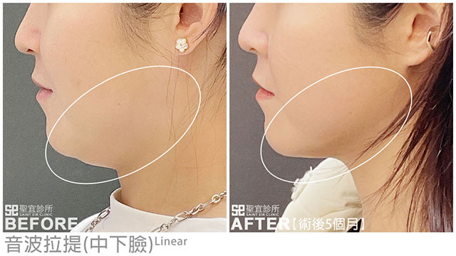 音波拉提案例見證(中下臉)