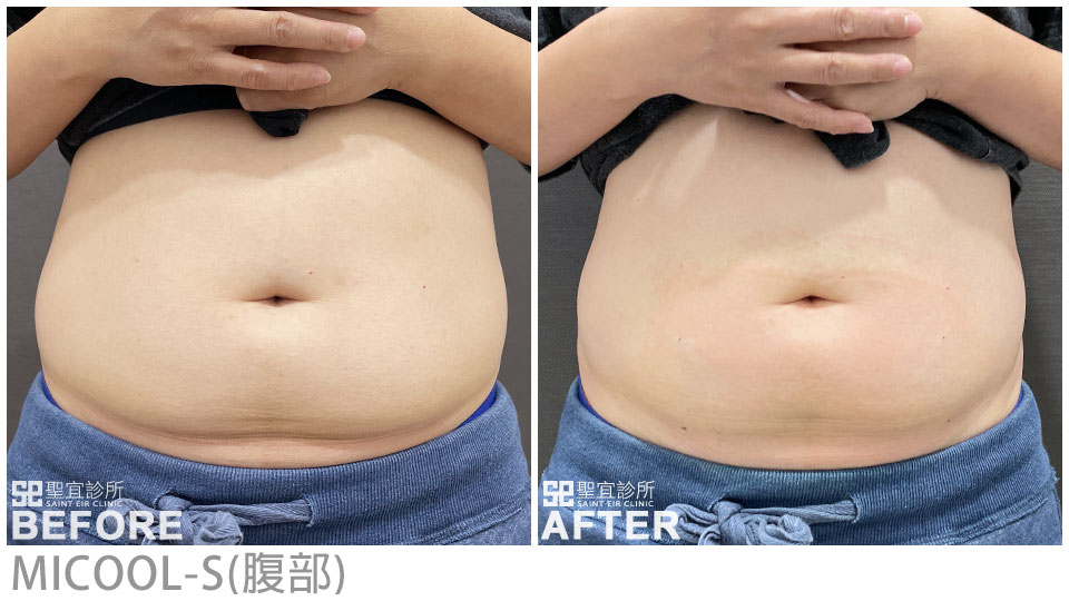 MICOOL-S(腹部)．dr翁書賢