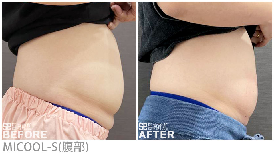 MICOOL-S(腹部)．dr翁書賢