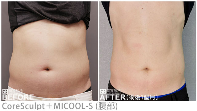CoreSculpt(腹部)