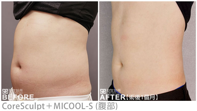 CoreSculpt(腹部)