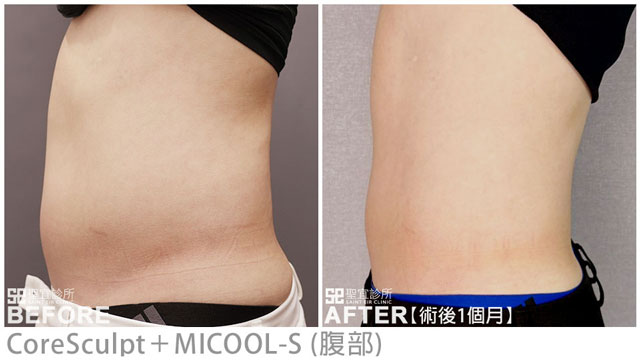 CoreSculpt(腹部)