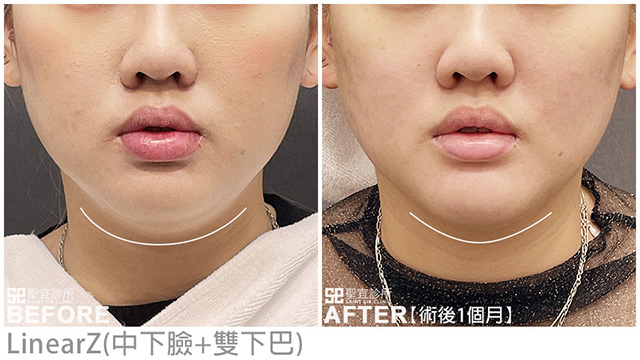 LinearZ(中下臉+雙下巴)．dr陳亮宇