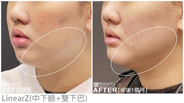 LinearZ(中下臉+雙下巴)．dr陳亮宇