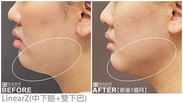 LinearZ(中下臉+雙下巴)．dr陳亮宇