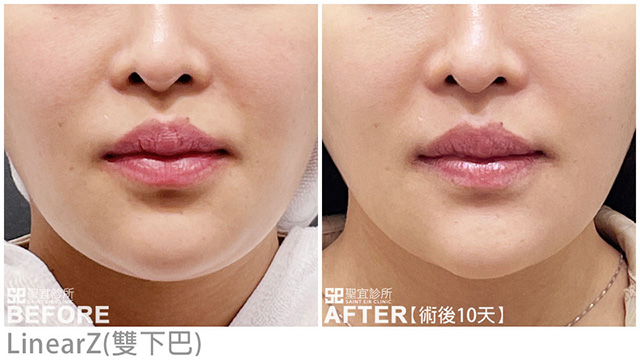 LinearZ(雙下巴)