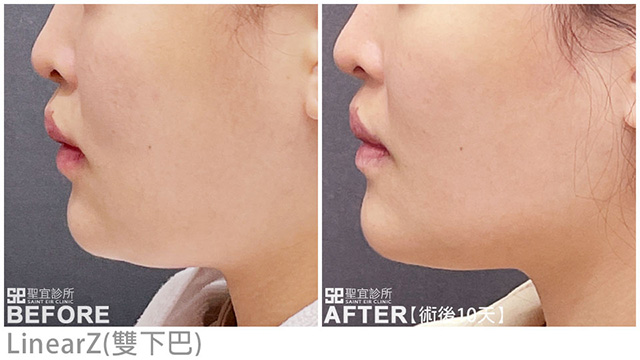 LinearZ(雙下巴)