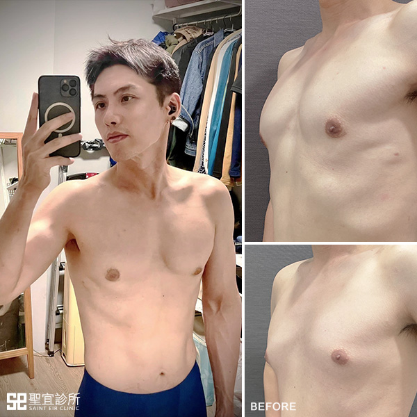 男性女乳症案例