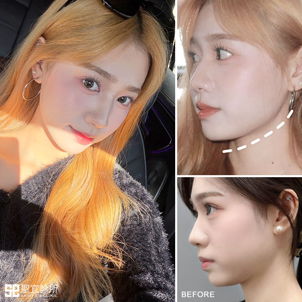 彩虹肉毒．dr林庭伊