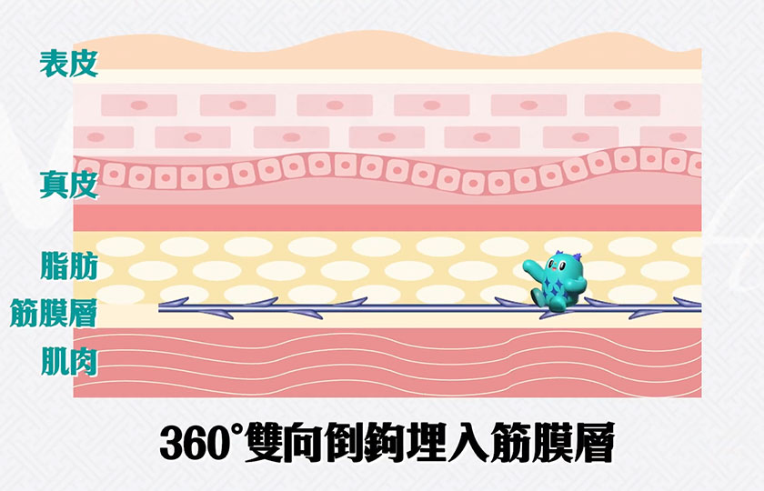 360度雙向倒鉤埋入筋膜層