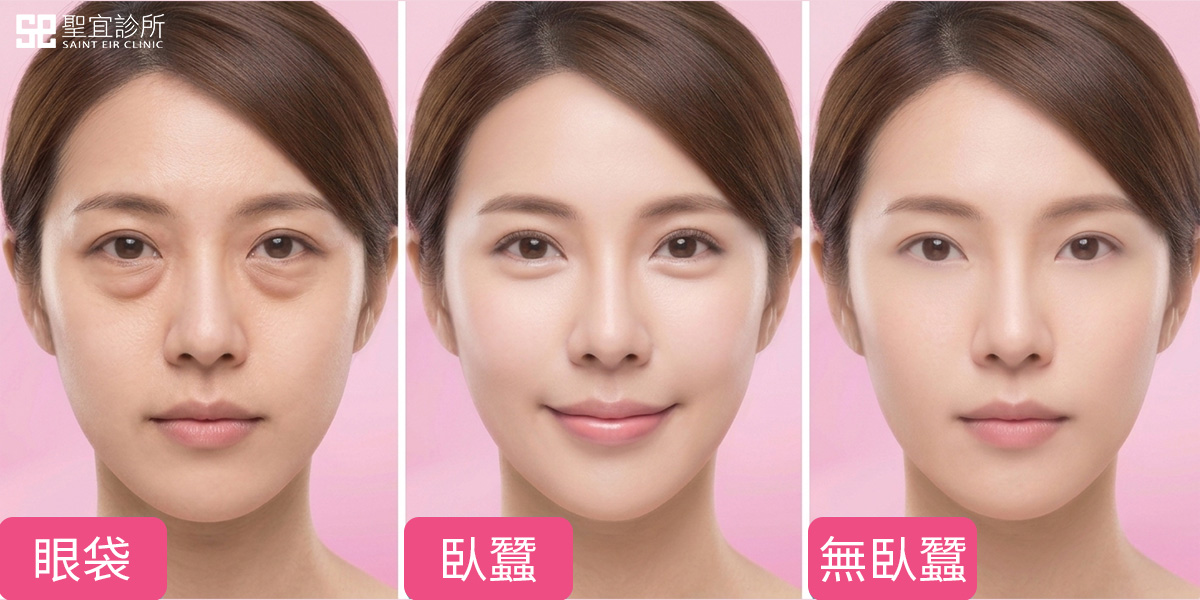 眼袋、臥蠶、無臥蠶示意圖