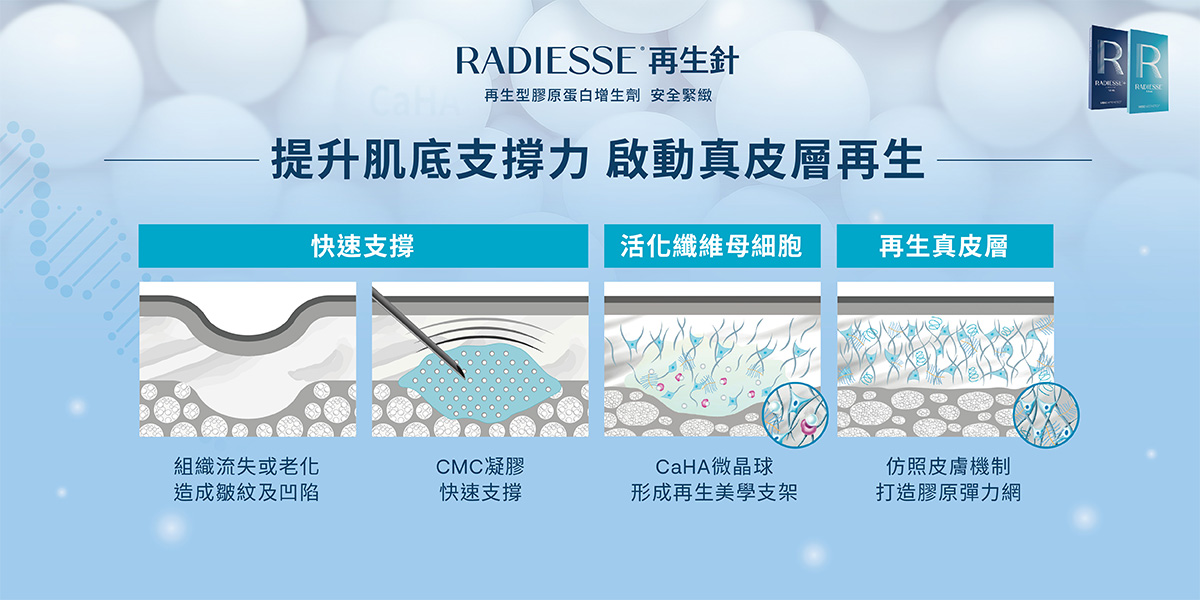 Radiesse再生針(晶亮瓷)-提升肌底支撐力,啟動真皮層再生