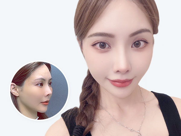 隱痕縮人中