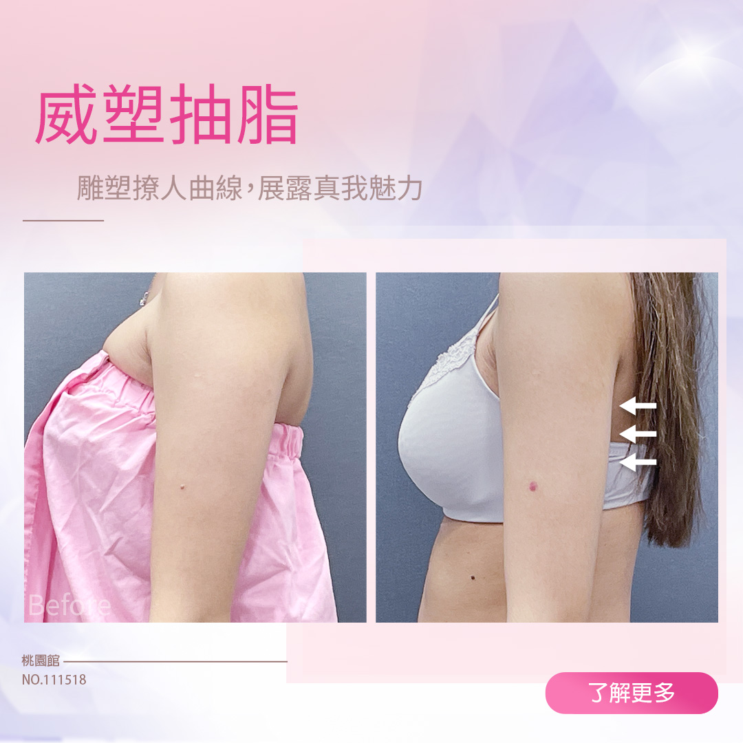 威塑抽脂